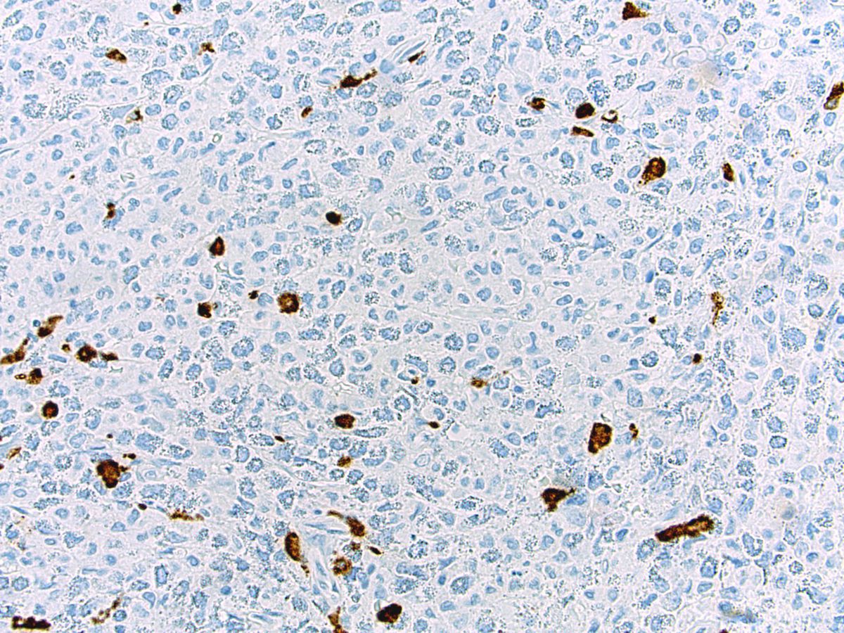 Tryptase IHC; original magnification 400X: No increase in mast cells.